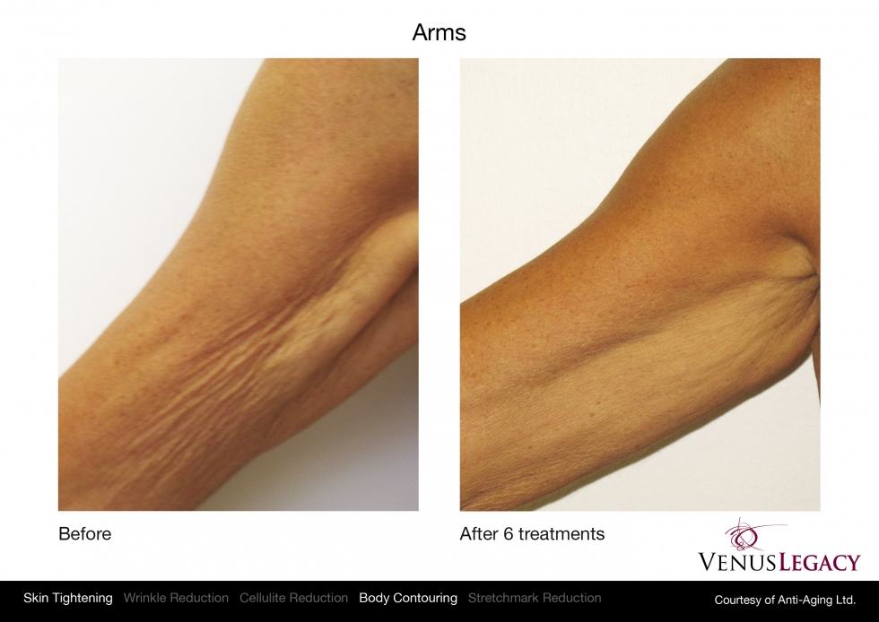 https://indylasercenter.com/wp-content/uploads/2014/10/skin_tightening_arms.jpg