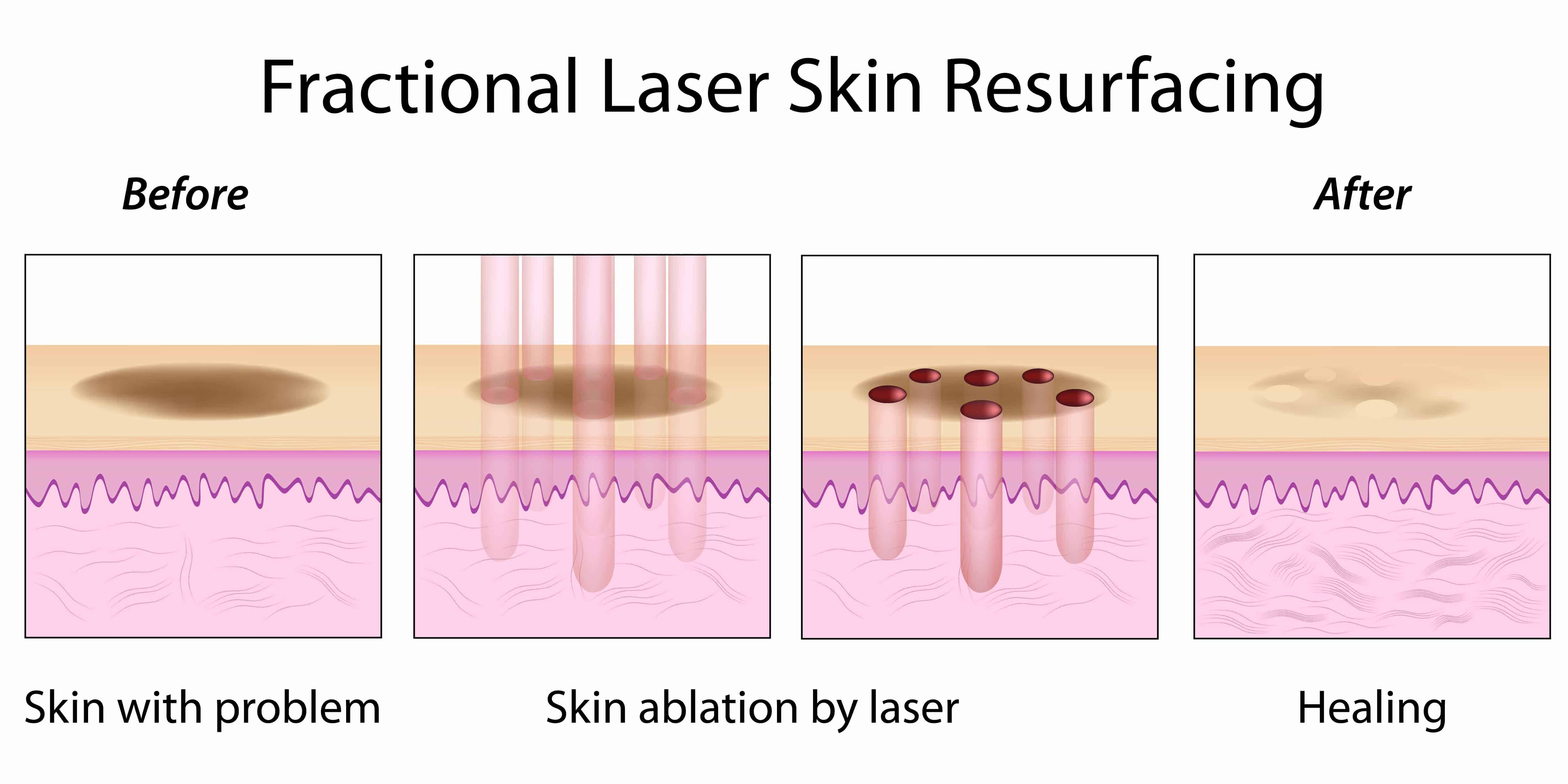 Viva Fractional Skin Resurfacing