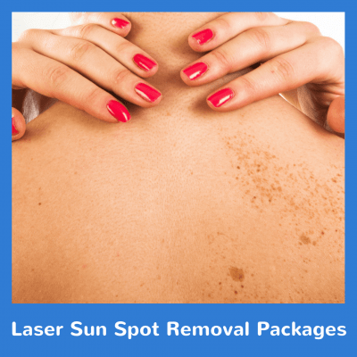 Laser Sun Spot Removal Packages