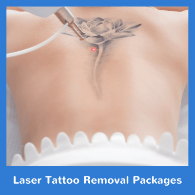 Laser Tattoo Removal Packages