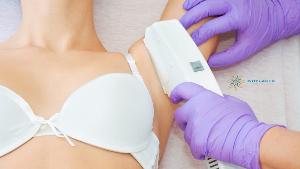 Armpit Laser Hair Removal Cost Information and Everything Else