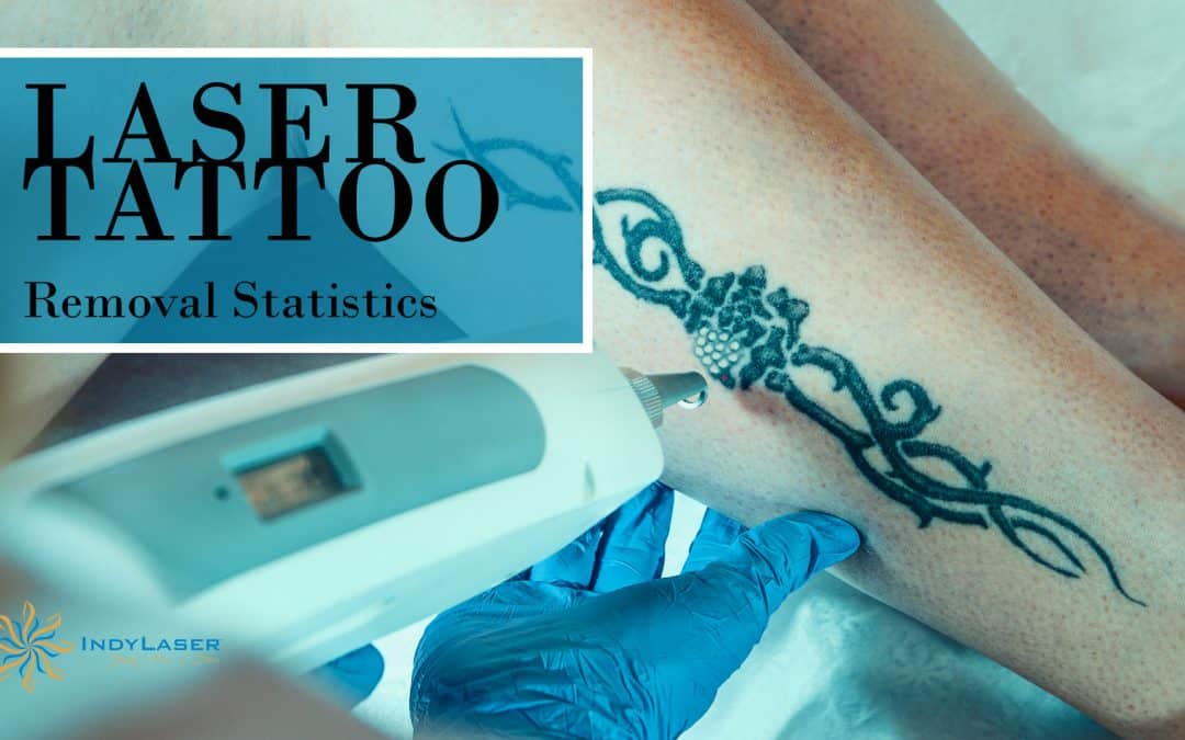 Laser Tattoo Removal Statistics