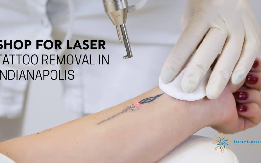 Shop For Laser Tattoo Removal In Indianapolis