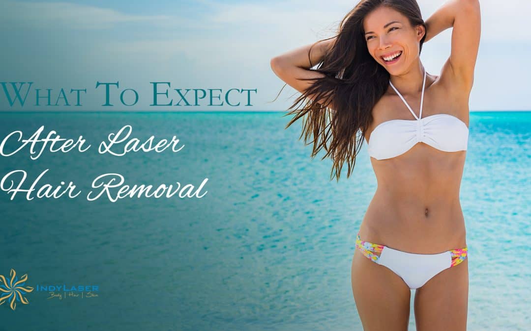 What To Expect After Laser Hair Removal
